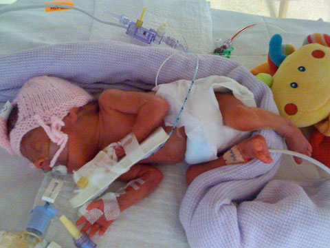 Cặp bé gái sinh đôi bé nhất nước Anh sống sót kỳ diệu