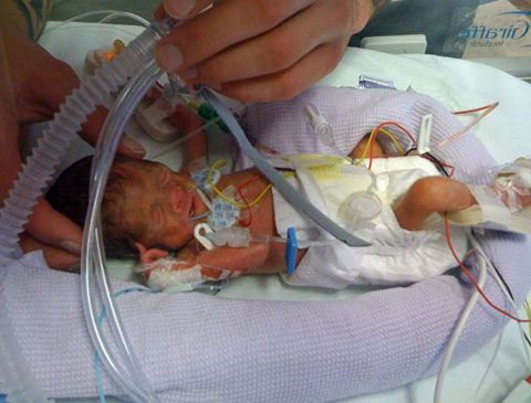 Cặp bé gái sinh đôi bé nhất nước Anh sống sót kỳ diệu