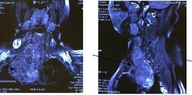 Bệnh nhân khó thở vì khối u chèn ép khí quản suốt 10 năm