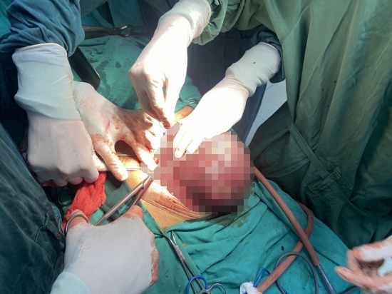 Phẫu thuật loại bỏ u nặng gần 3kg cho bệnh nhân 72 tuổi