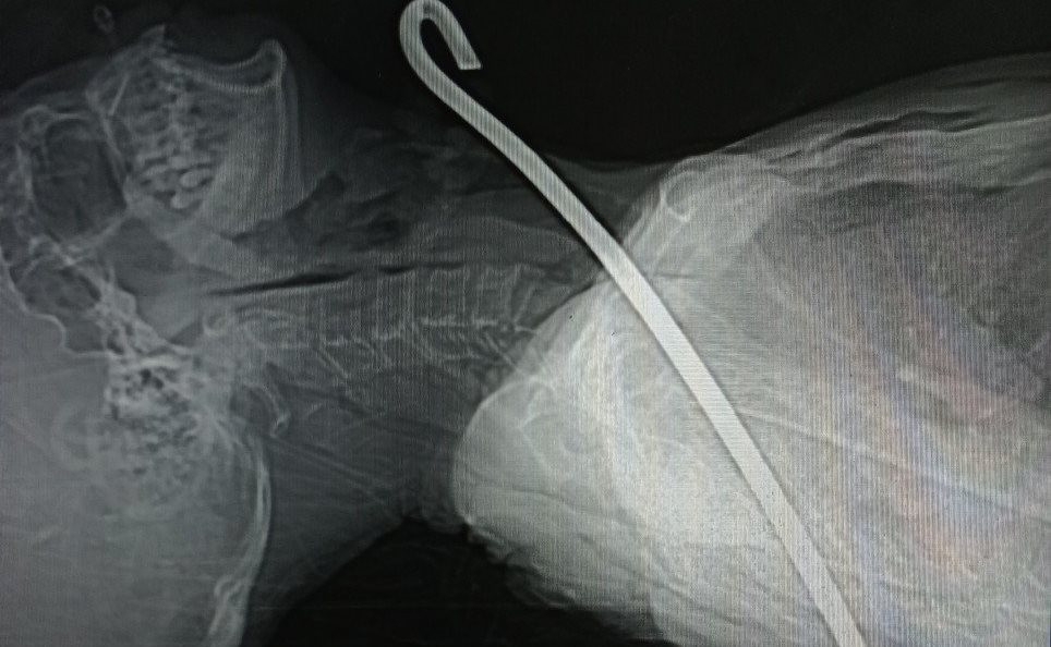 Hà Tĩnh: Phẫu thuật cứu thành công bệnh nhân bị cây sắt đâm thấu từ cổ xuống phổi