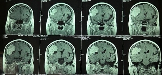TP.HCM: Cắt bỏ thành công khối u màng não to hơn quả trứng