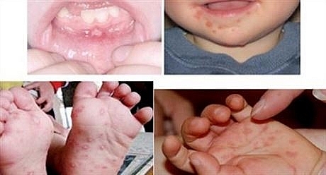 Nhận biết sớm dấu hiệu bệnh tay chân miệng ở trẻ để xử lý kịp thời