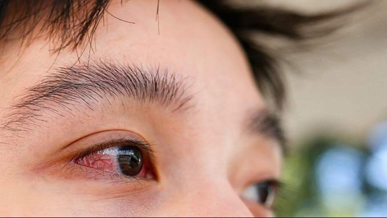 Đồng Nai: Ghi nhận hơn 18.000 trường hợp mắc bệnh đau mắt đỏ