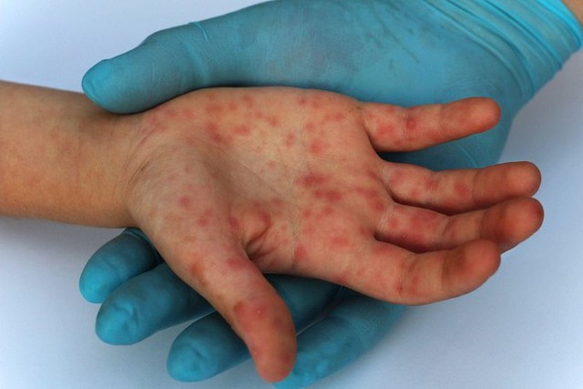 TPHCM: Phát hiện ca bệnh đậu mùa khỉ thứ 5