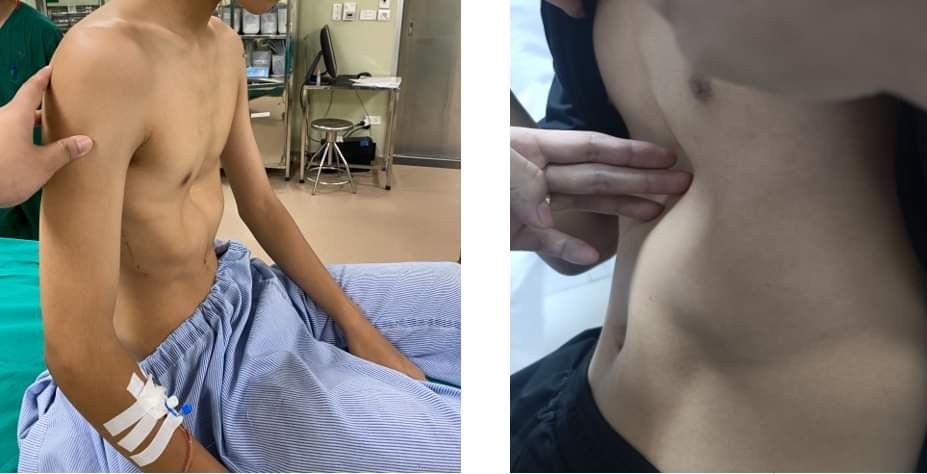 Phẫu thuật thành công cho nam bệnh nhân bị lõm ngực bẩm sinh