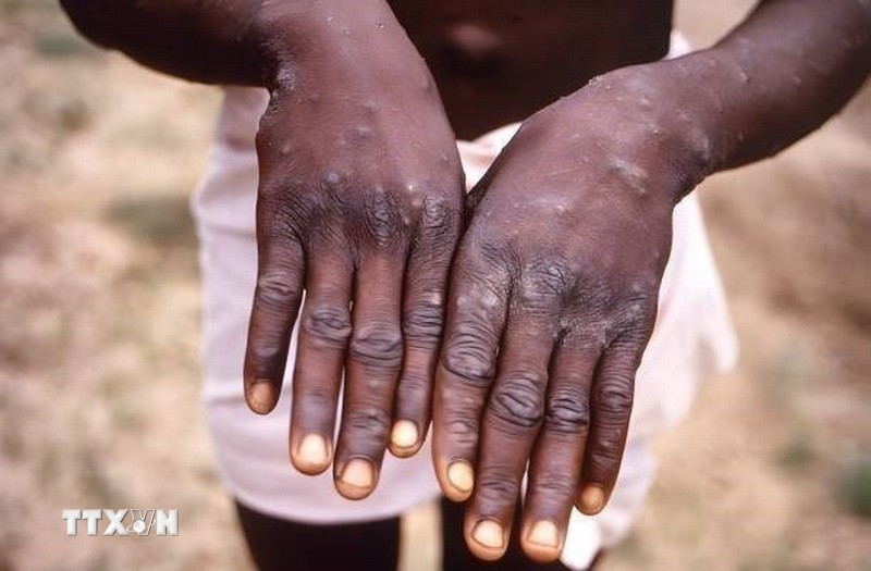 Bệnh nhân mắc đậu mùa khỉ ở Cộng hòa Dân chủ Congo. (Nguồn: Getty Images/TTXVN)