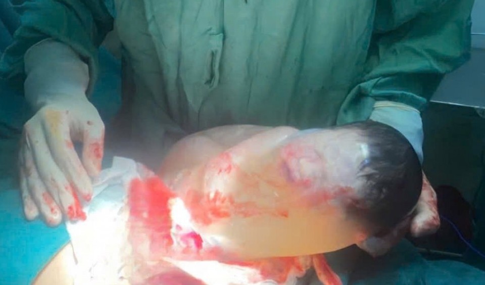 Bé sơ sinh chào đời còn nguyên trong bọc ối vô cùng hiếm gặp