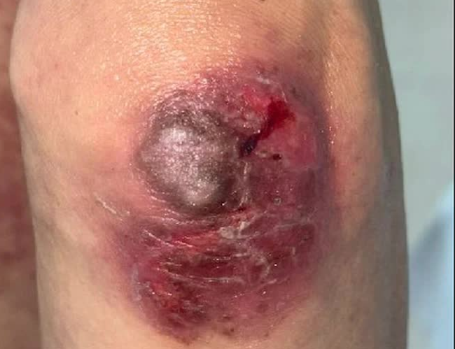 Ngộ độc thuốc methotrexate do sử dụng sai liều