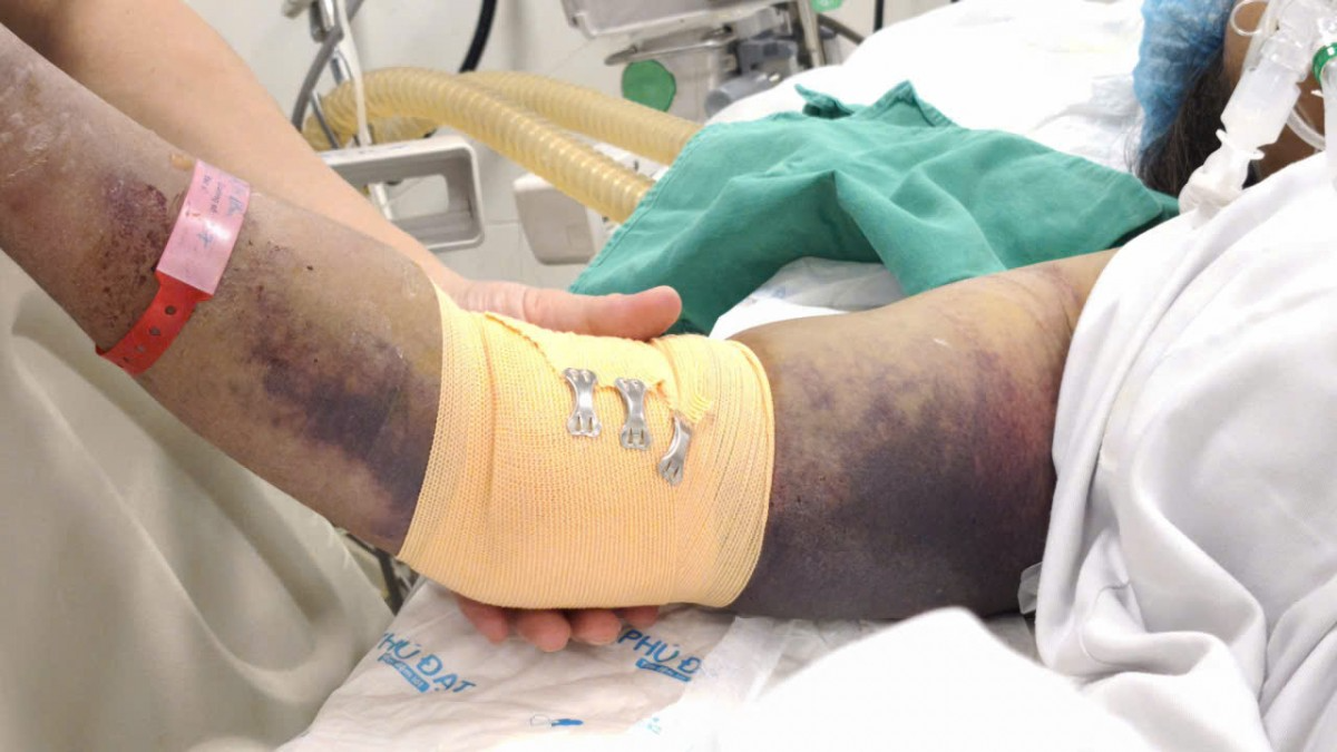 Cảnh báo gia tăng ca mắc sốt xuất huyết sau mưa bão Cảnh báo gia tăng ca mắc sốt xuất huyết sau mưa bão