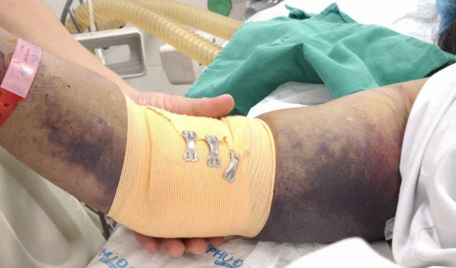 Hà Nội ghi nhận thêm 120 ca sốt xuất huyết tại 67 phường, xã