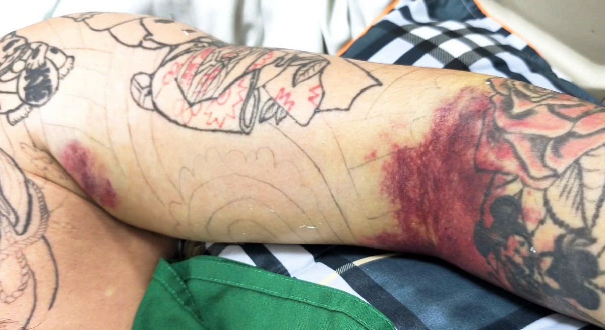 Nam thanh niên bị biến chứng nguy hiểm vì sốt xuất huyết