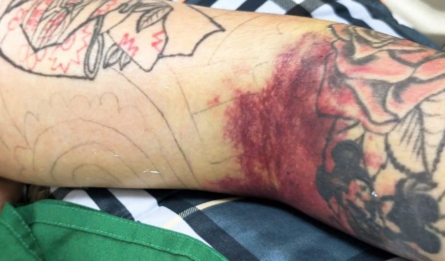 Nam thanh niên bị biến chứng nguy hiểm vì sốt xuất huyết