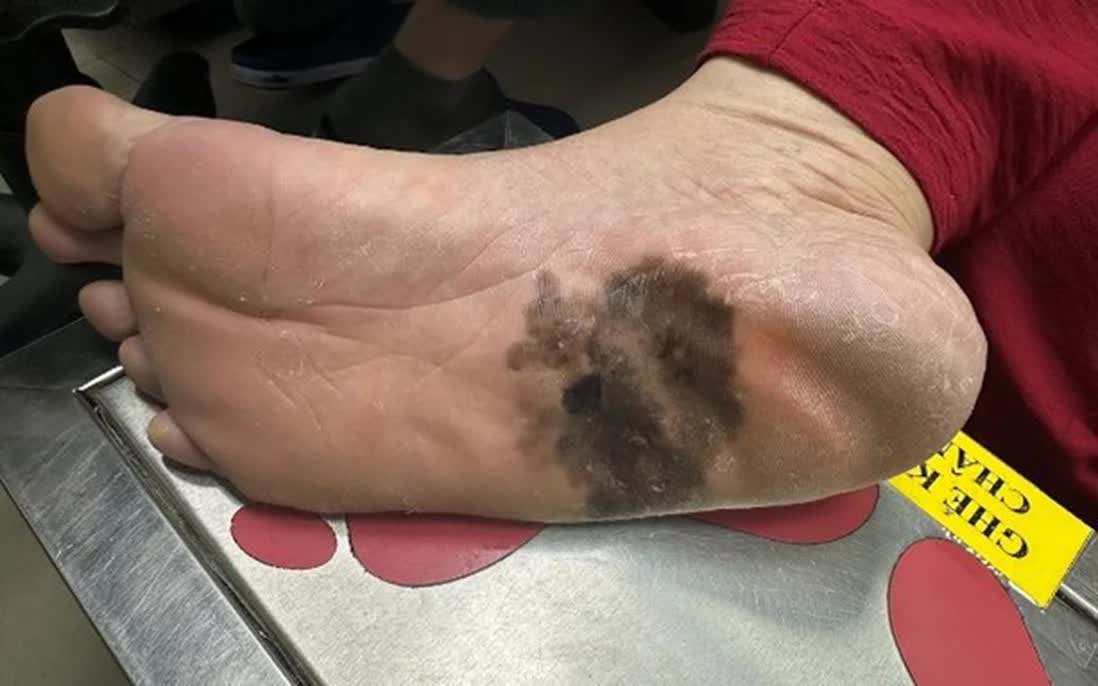 Đừng chủ quan với ung thư tế bào hắc tố: Ác tính cao, di căn nhanh Đừng chủ quan với ung thư tế bào hắc tố: Ác tính cao, di căn nhanh