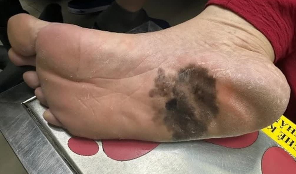 Đừng chủ quan với ung thư tế bào hắc tố: Ác tính cao, di căn nhanh