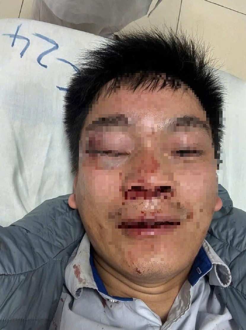 Lái xe buýt bị hành hung khi đang đón khách, phải nhập viện cấp cứu Lái xe buýt bị hành hung khi đang đón khách, phải nhập viện cấp cứu