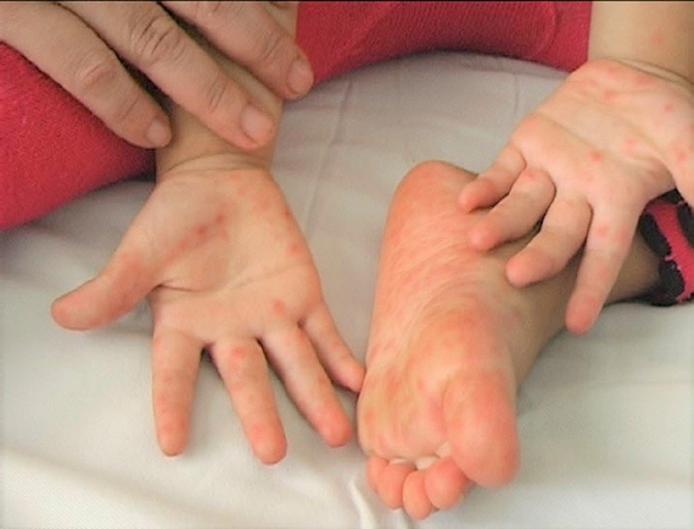Bộ Y tế yêu cầu khẩn cấp phòng, chống dịch bệnh tay chân miệng