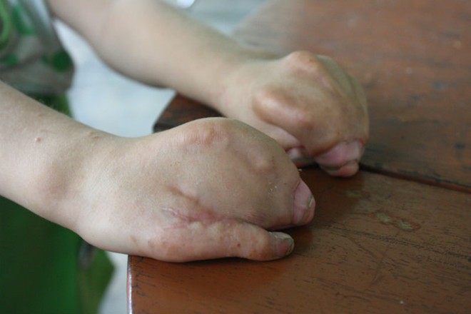 Sau lần đầu tiên phẫu thuật, một ngón tay của bé đã tách thành công. 