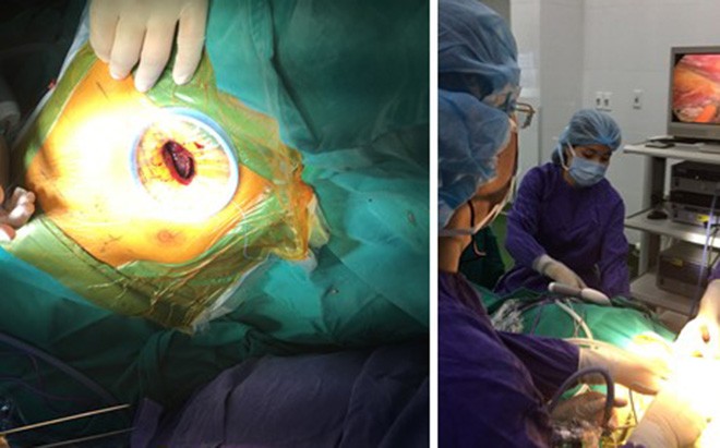 Lần đầu tiên Việt Nam phẫu thuật cắt u phổi không cần thở máy hỗ trợ