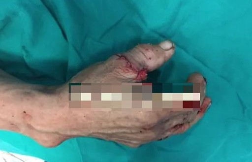 Phẫu thuật nối thành công ngón tay cái đứt rời cho bệnh nhân 67 tuổi