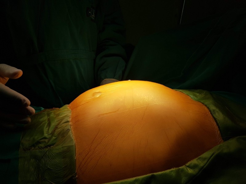 Phẫu thuật loại bỏ u mạc treo ruột khủng nặng 4kg cho bệnh nhân