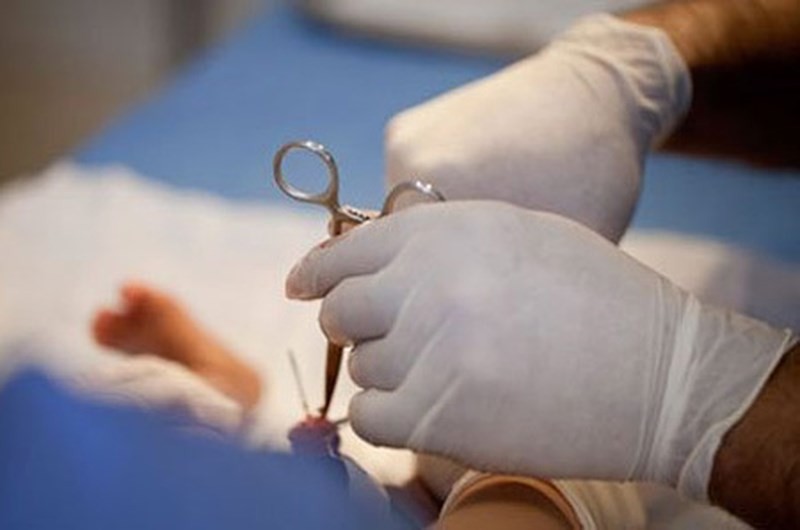 Bệnh nhân bị phù nề khi cắt bao quy đầu ở phòng khám tư