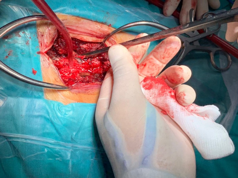 phau thuat cuu song benh nhan bi di vat cam vao tuy song