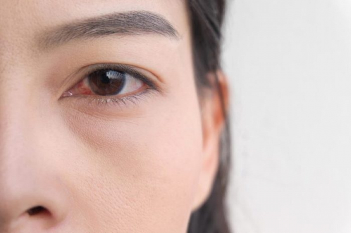 Khó mở mắt: Nếu vào buổi sáng thức dậy, bạn cảm thấy khó khăn trong việc mở mắt, không phải do ngái ngủ mà do hai mí mắt như bị dính vào nhau, đó có thể là dấu hiệu của một dạng nhiễm khuẩn mắt ví dụ như đau mắt đỏ./.
