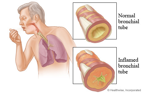 "Thủ phạm" gây viêm phế quản cấp