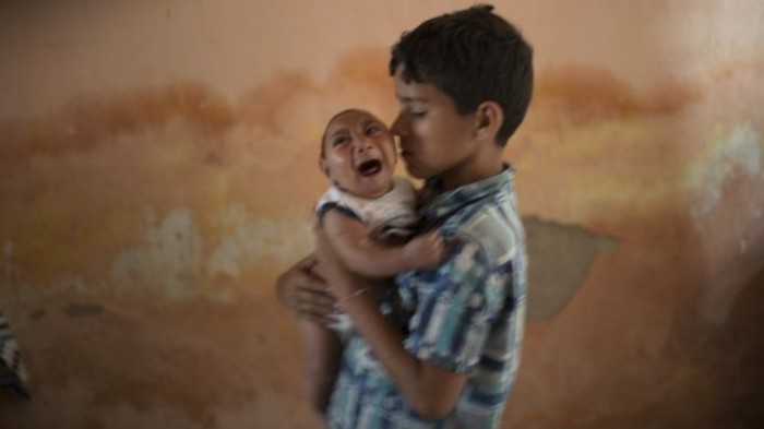 Bùng phát virut Zika gây dị tật đầu nhỏ trẻ em ở Brazil