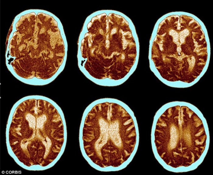 Xét nghiệm máu giúp phát hiện sớm bệnh Alzheimer