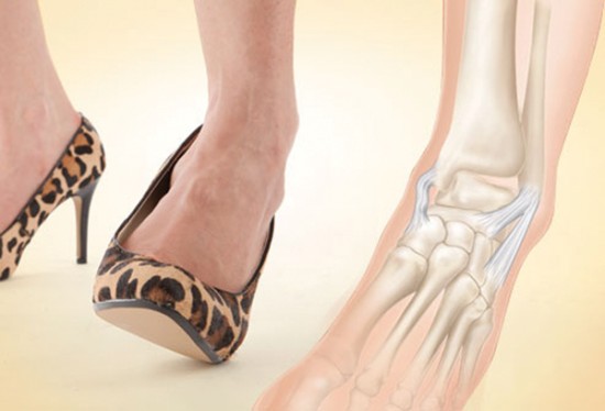 Hoại tử sụn gối và tăng nguy cơ viêm xương khớp vì giày cao gót