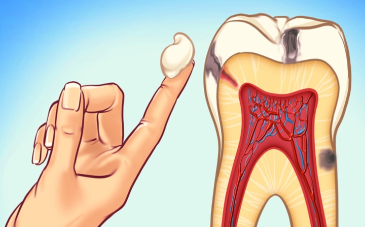 9 cách đơn giản để ngăn ngừa sâu răng
