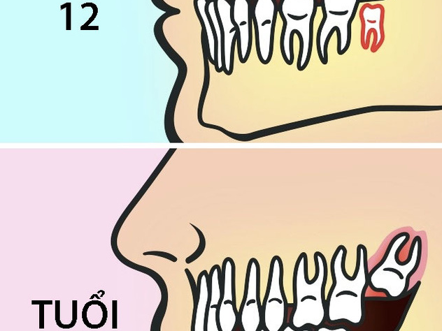Vì sao nên nhổ răng khôn trước 25 tuổi?