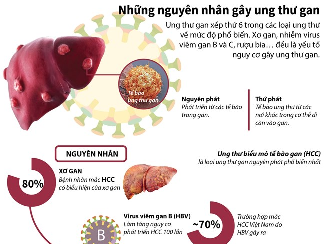 [Infographics] Tìm hiểu những nguyên nhân gây ung thư gan