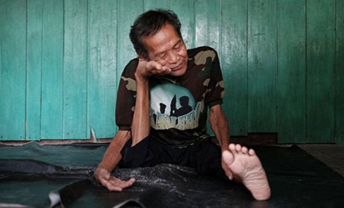 Cụ ông “không xương” ở Indonesia