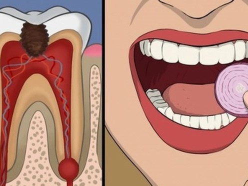 11 cách giúp bạn dịu cơn đau do mọc răng khôn