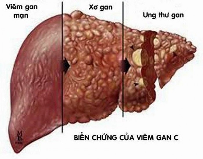 Viêm gan C âm thầm 'giết người' khủng khiếp thế nào?