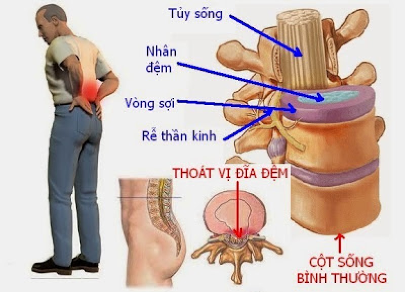 Cần hiểu đúng về bị thoát vị