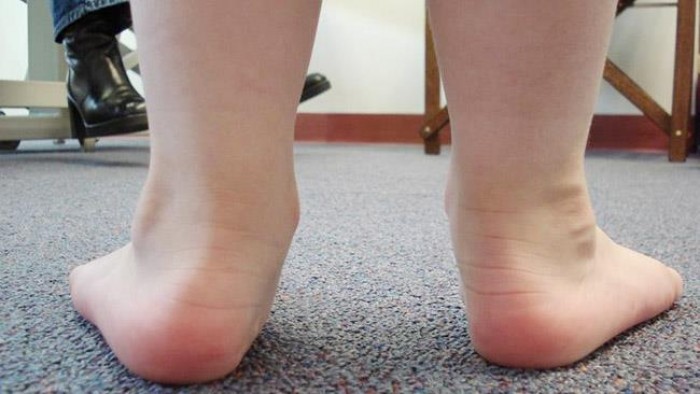 Dị tật bàn chân bẹt ở trẻ