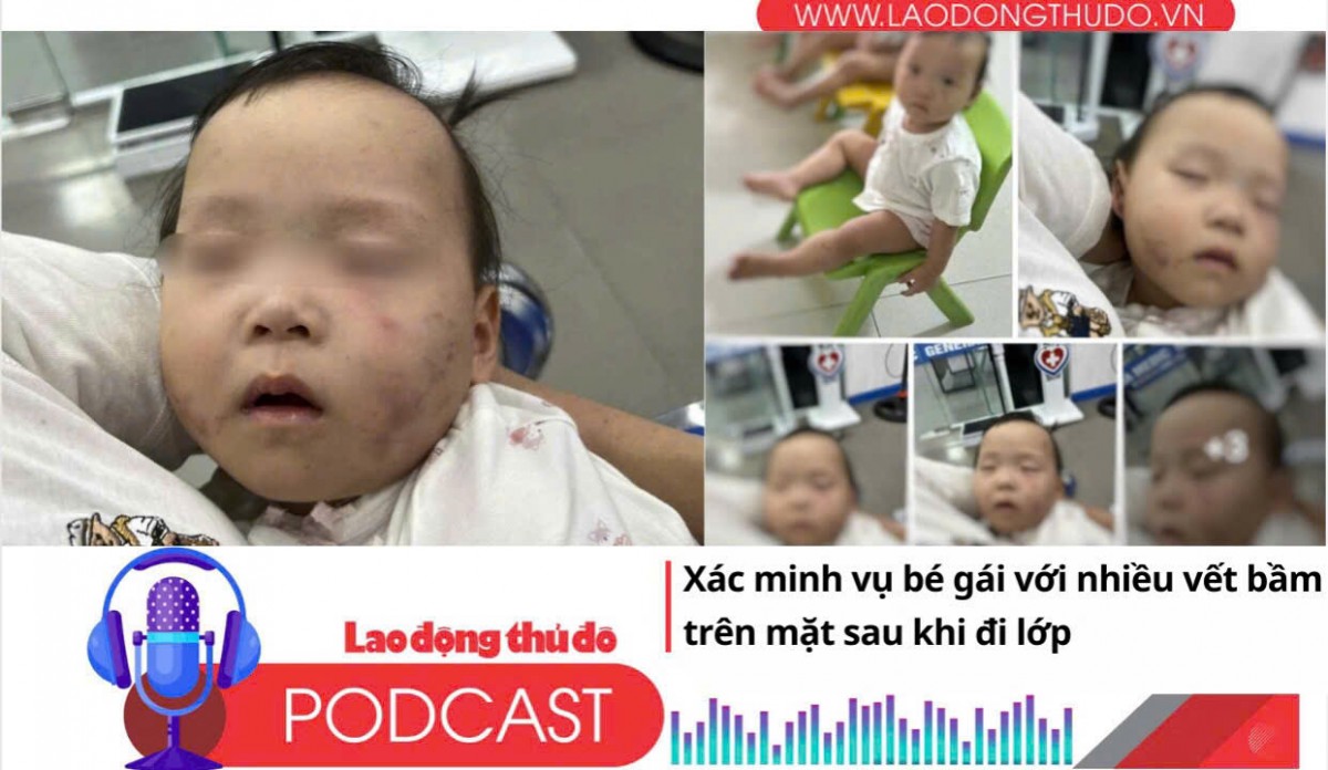 Điểm những tin nổi bật sáng ngày 5/9/2025: Xác minh vụ bé gái với nhiều vết bầm trên mặt sau khi đi lớp